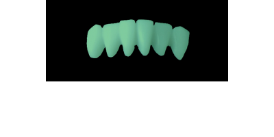 Cod.C14Facing : 10x  wax facings-bridges,  MEDIUM, Overlapping, TOOTH 43-33, compatible with Cod.A14Lingual,TOOTH 43-33 for long-term provisionals preparation